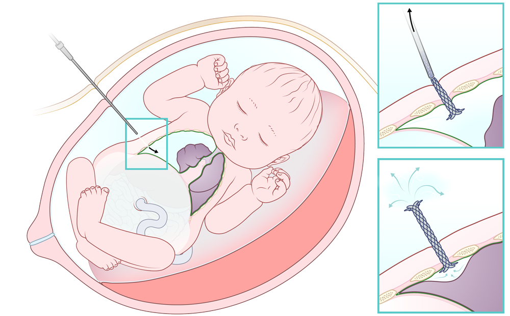 hydrothorax shunt plaatsing foetale therapie