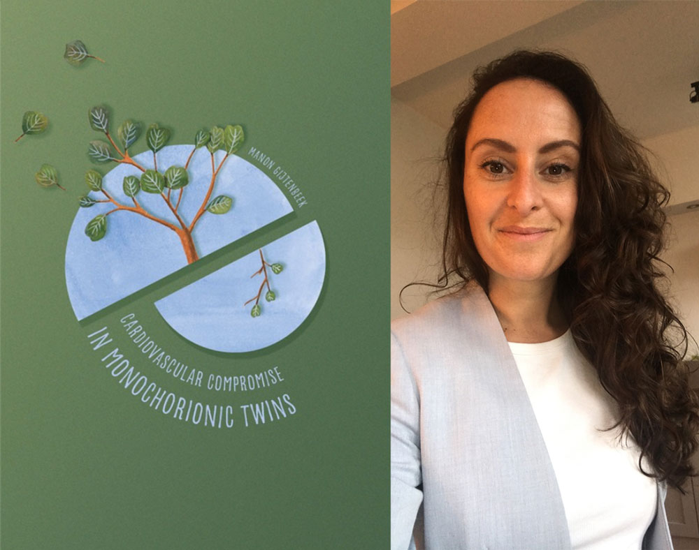 proefschrift cardiovascular compromise in monochorionic twins manon gijtenbeek foetale therapie