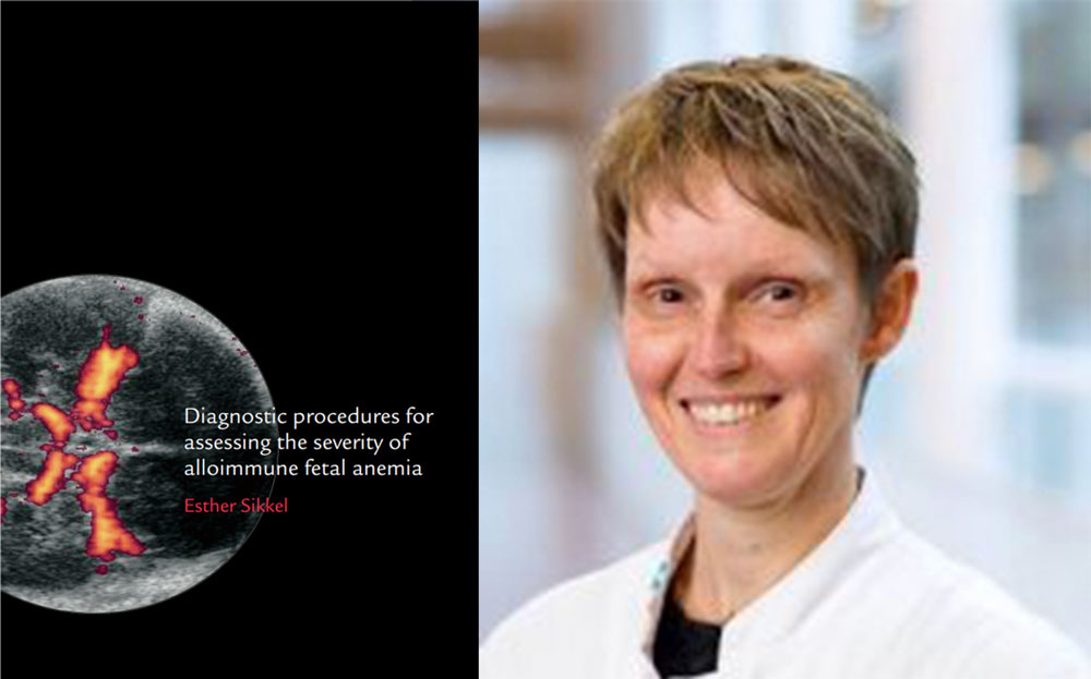 proefschrift diagnostic procedures for assessing the severity of alloimmune fetal anemia esther sikkel foetale therapie