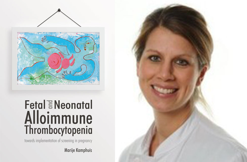 proefschrift fetal and neonatal alloimmune thrombocytopenia marije kamphuis foetale therapie