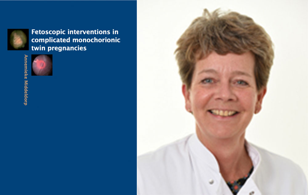 proefschrift fetoscopic interventions in complicated monochorionic twin pregnancies annemieke middeldorp foetale therapie