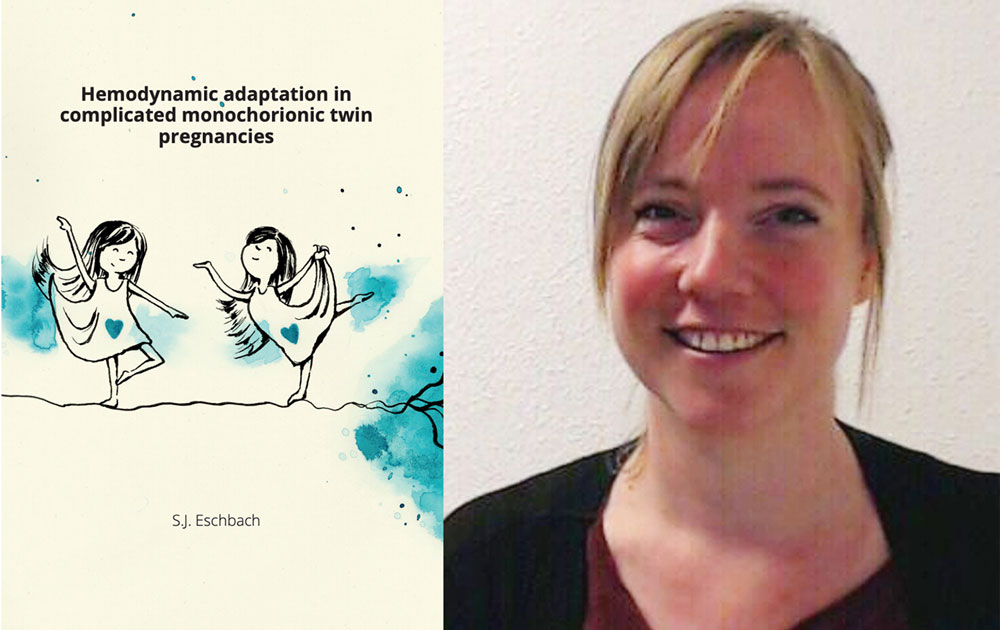 proefschrift hemodynamic adaptation in complicated monochorioic twin pregnancies sanne esbach foetale therapie