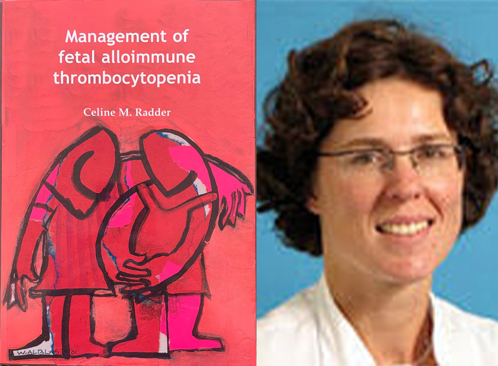 proefschrift management of fetal alloimmune thrombocytopenia celine radder foetale therapie
