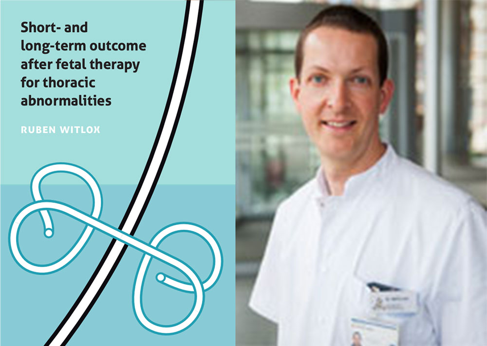 proefschrift short and long term outcome after fetal therapy for thoracic abnormalities ruben witlox foetale therapie