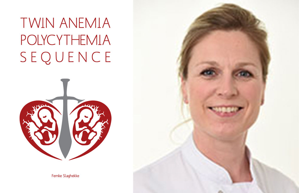 proefschrift twin aenemia polycythemia sequence femke slaghekke foetale therapie