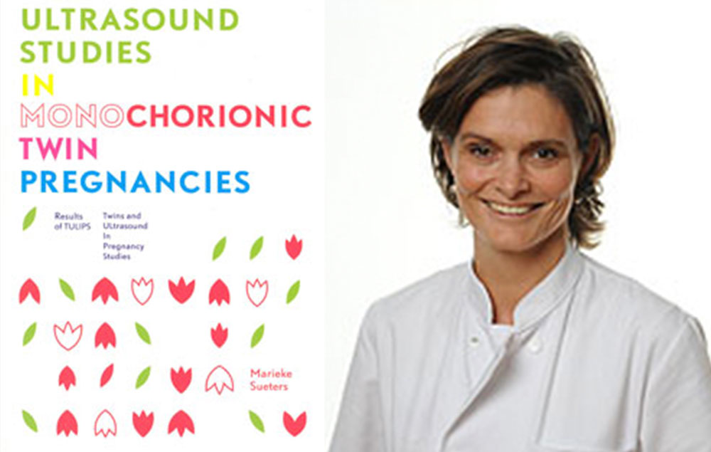 proefschrift ultrasound studies in monochorionic twin pregnancies marieke sueters foetale therapie