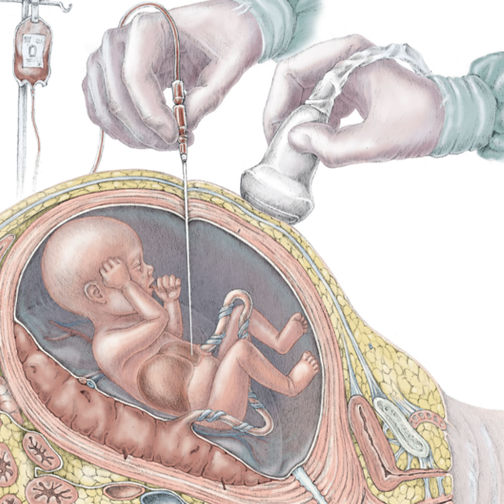 behandeling intra uteriene transfusie foetale therapie