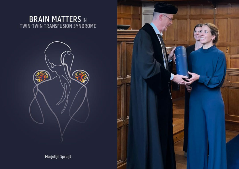 proefschrift brain matters in twin twin transfusion syndrome marjolein sprujt foetale therapie leiden