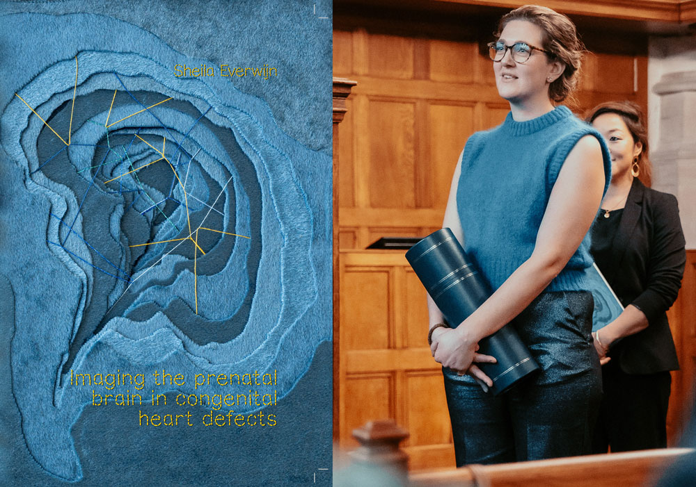 proefschrift imaging the prenatal brain in congenital heart defects sheila everwijn foetale therapie leiden